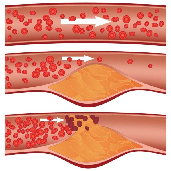 Plaque Buildup In Your Arteries Can You Stop It And How