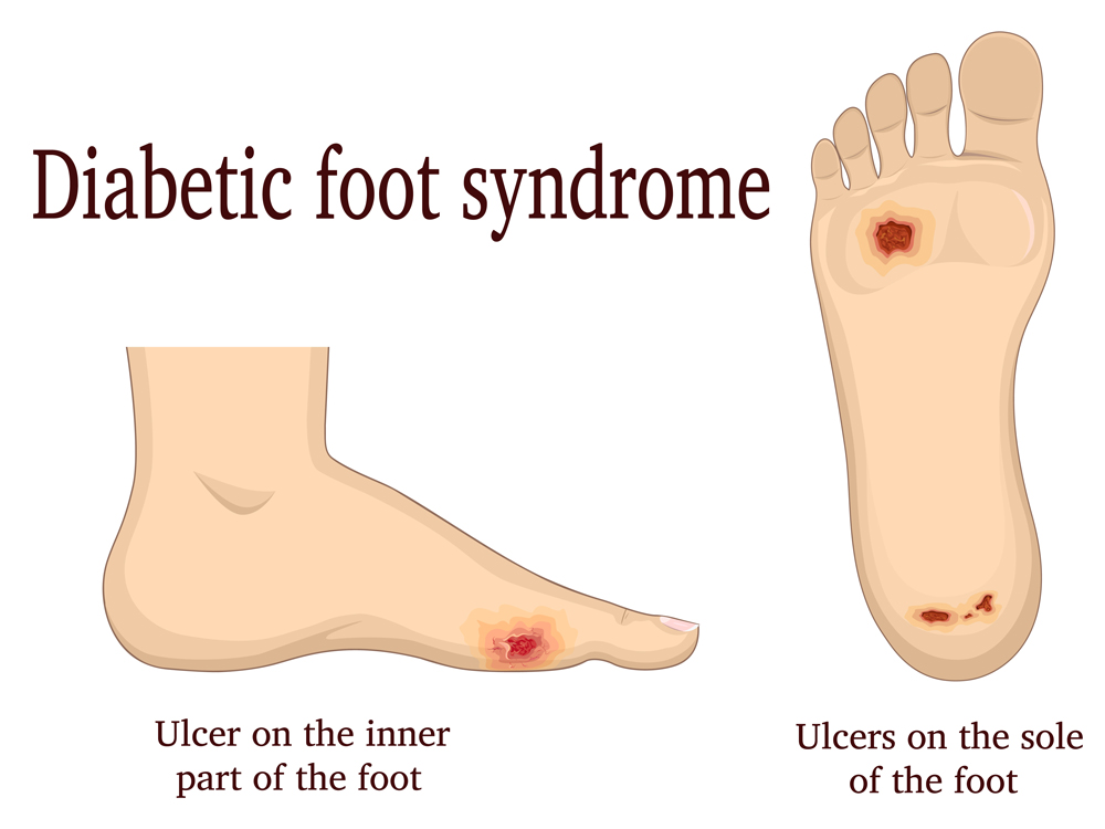 Visual illustration of diabetes wounds and ulcers on foot.