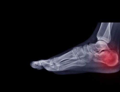 Prevent a Broken Ankle from Becoming a Chronic Condition